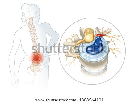 illustration showing lumbal vertebra with intervertebral disc and herniated nucleus pulposus Stockfoto © 