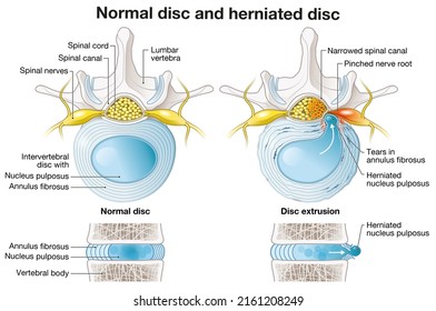 Illustration showing normal disc and herniated disc, slipped disc, illustration