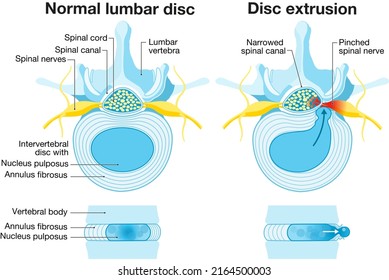 Illustration showing normal disc and herniated disc. Normal disc. Bulge. Protrusion. Extrusion. Sequestration. Labeled illustration