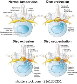 Illustration showing normal lumbar disc and disc protrusion and disc extrusion and disc sequestion. 