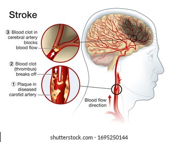 Illustration showing plaque in carotid artery, blood clot breaking off and blocking blood flow