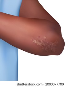 Illustration Showing Psoriasis On The Arm. Psoriasis Is A Skin Condition Where Excessive Growth Of Skin Cells Can Lead To Itchy, Scaly, Thickened Patches Plaques Of Skin Which May Become Infected.