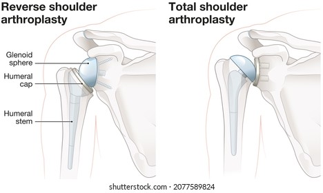 Illustration Showing Reverse Shoulder Arthroplasty And Total Shoulder Arthroplasty