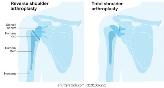 Illustration Showing Reverse Shoulder Arthroplasty And Total Shoulder Arthroplasty