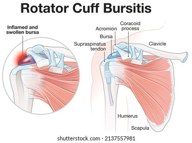 Illustration Showing Rotator Cuff Bursitis