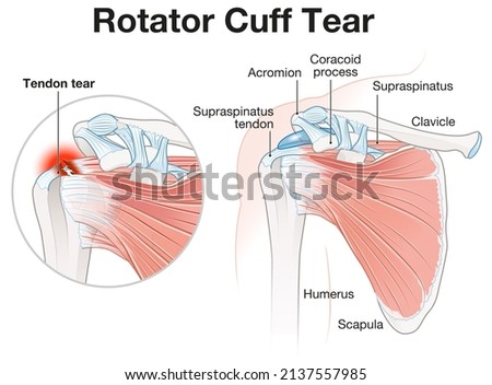 Illustration showing rotator cuff tear shoulder illustration Imagine de stoc © 