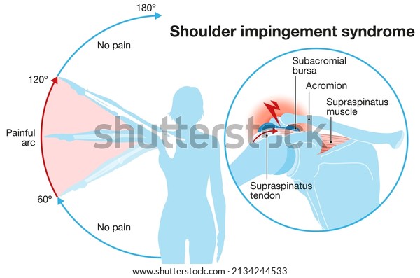 Illustration showing shoulder impingement syndrome\
and painful\
arc