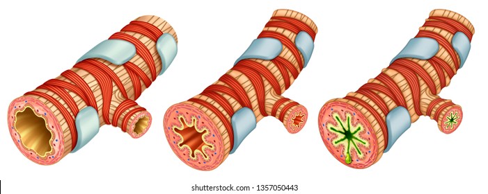 Illustration Showing Three Portions Of The Bronchi, One Healthy And Another Inflamed And The Third With A Severe Asthma, With Respiratory Tract Completely Obstructed.