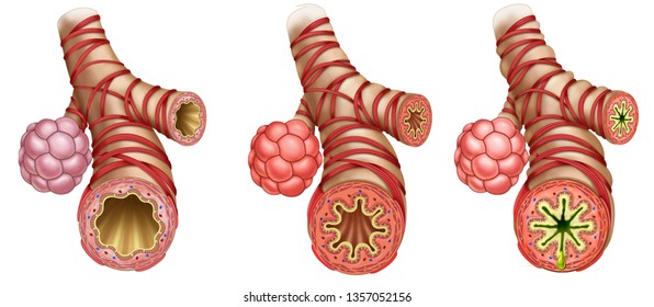 Illustration showing three portions of bronchi and arveoli, one healthy and one inflamed and the third with severe asthma, with the respiratory tract totally obstructed.