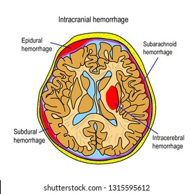 207 Intracranial hemorrhage Images, Stock Photos & Vectors | Shutterstock