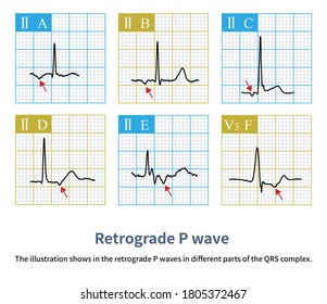 The Illustration Shows In The Retrograde P Waves In Different Parts Of The QRS Complex.