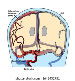 the illustration shows ruptured intracranial cerebral aneurysm with subarachnoid hemorrhage.