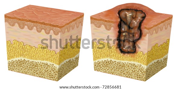 Illustration Skin Ulceration Stock Illustration 72856681 | Shutterstock