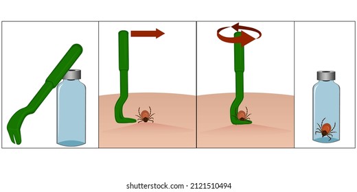 Illustration of special tweezers for removing ticks. Instructions for removing a tick with special tweezers. Tick ​​bite. Placing the tick in a container