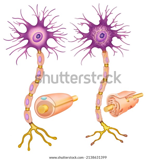 Illustration of the structure of a healthy and a\
diseased neuron. One is normal and the other shows demyelination,\
in which the layer that covers the nerve fibers of the axons of\
neurons is\
damaged.