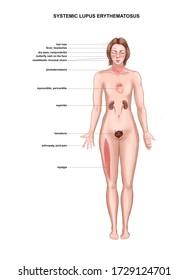 Illustration Of Symptoms Of Systemic Lupus Erythematosus