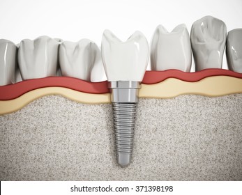 Illustration Of Teeth Showing Dental Implant Structure