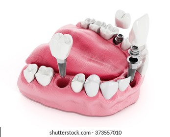 Illustration Of Teeth Showing Dental Implant Structure