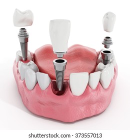 Illustration Of Teeth Showing Dental Implant Structure