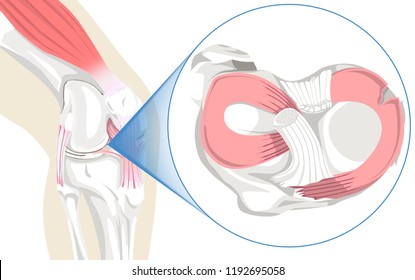 Illustration Of A Torn Meniscus