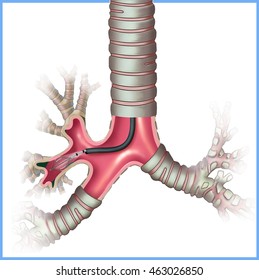 Illustration of the trachea bronchoscopy examination.