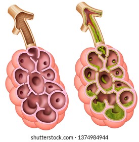 Illustration with two examples of an alveolar sac belonging to the human respiratory system, a healthy alveolar sac and another alveolar sac affected by a cystic fibrosis.
