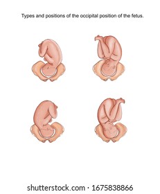 Illustration of the types and positions of the occipital position of the fetus