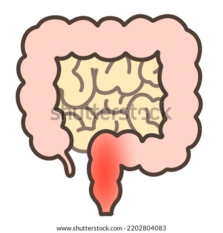 A illustration of Ulcerative colitis.