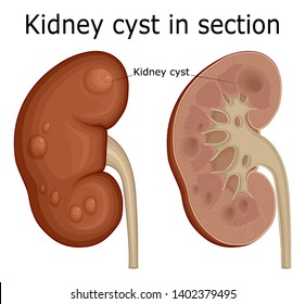 Illustration Of A Urological Disease Of A Kidney Cyst In A Section