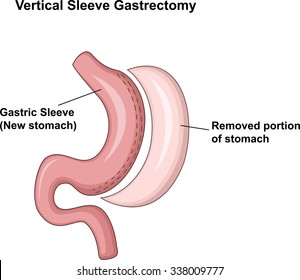 Illustration of Vertical Sleeve Gastrectomy (VSG)
