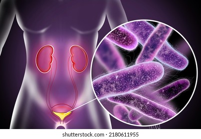 Illustration Of Woman Suffering From Cystitis. Urinary Infection