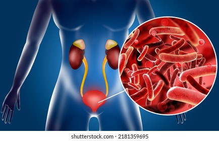 Illustration Of Woman Suffering From Cystitis. Urinary Infection