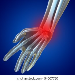 An Illustration Of A Wrist Xray Showing The Injury Highlighted In Red.