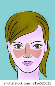 Illustration Of Young Woman With Lupus Syndrome. Butterfly Rash O The Face