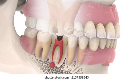 Illustrations Of Dental Disease. Image Of Pulpitis.