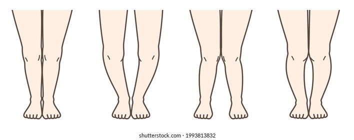 5,204 Leg deformity Images, Stock Photos & Vectors | Shutterstock