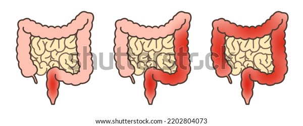 Illustrations Ulcerative Colitis Explain Stock Illustration 2202804073 Shutterstock 