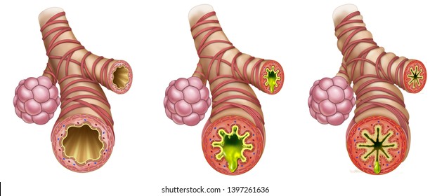 1,904 Bronchospasm Images, Stock Photos & Vectors | Shutterstock