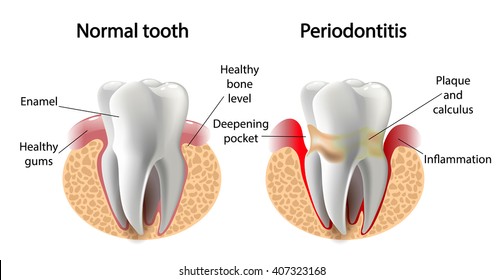  image tooth caries disease. Surface caries.Deep caries  Pulpitis Periodontitis.