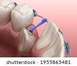Impacted Cuspid and elastic for correction. Medically accurate dental 3D illustration