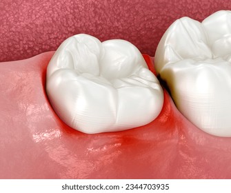 Impaction of Wisdom teeth, gum inflammation. 3D illustration