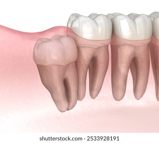 Impaction of Wisdom tooth. Medically accurate tooth 3D illustration