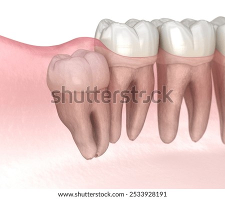Impaction of Wisdom tooth. Medically accurate tooth 3D illustration