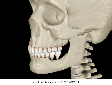 1,117 Bones exposed Images, Stock Photos & Vectors | Shutterstock