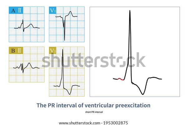 Individuals Atrioventricular Accessory Pathway Partial Ventricular ...