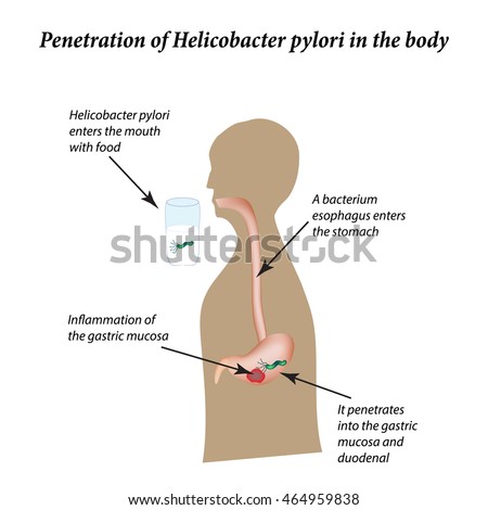 helicobacter pylori esophagus diagram wiring diagram img Helicobacter Pylori and Asthma infection helicobacter pylori infographics illustration on stock pseudomonas aeruginosa diagram helicobacter pylori esophagus diagram