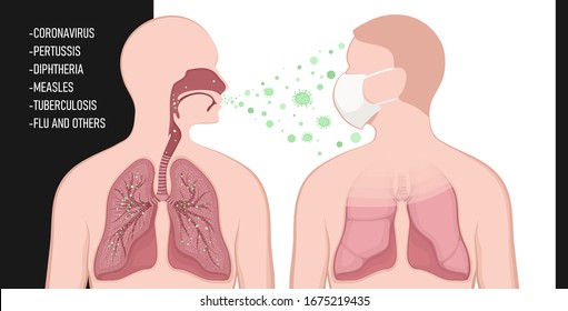 575 Tuberculosis spread Images, Stock Photos & Vectors | Shutterstock