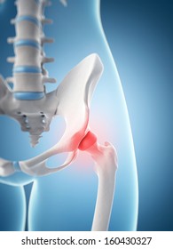 inflamed hip joint
