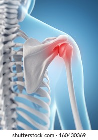 Inflamed Shoulder Joint