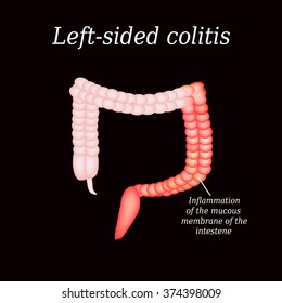 Inflammation Large Intestine Divisions Illustration On Stock ...